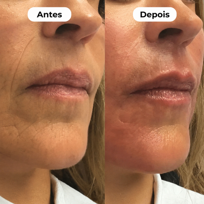 Zyvarn™ Sérum Microinfusão Anti-Aging [Botox em Casa. Sem Agulha. Sem Médico.]